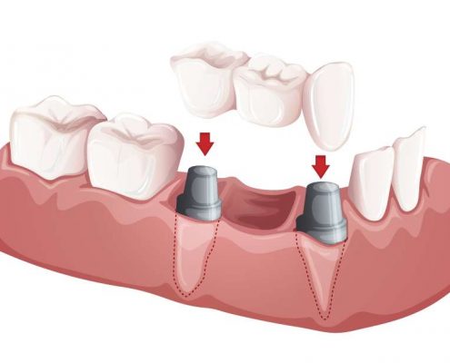 Dentista en Villa del Prado, implantes dentales