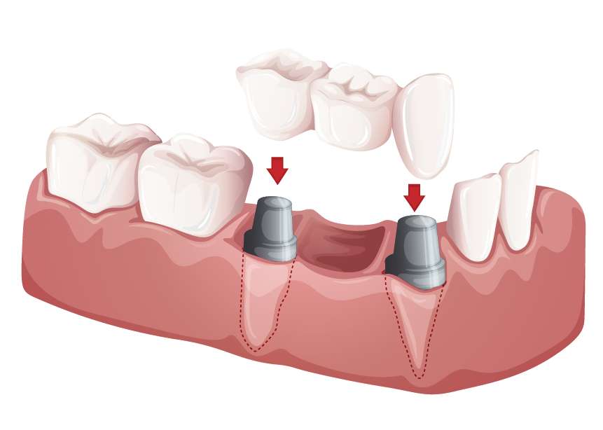 ¿Duelen los implantes dentales?