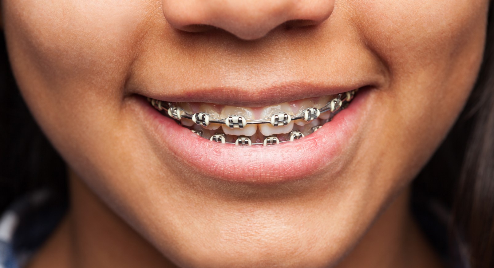 ¿Qué tipo de ortodoncia me conviene más?