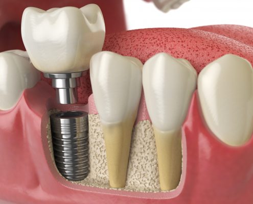 ventajas de los implantes dentales
