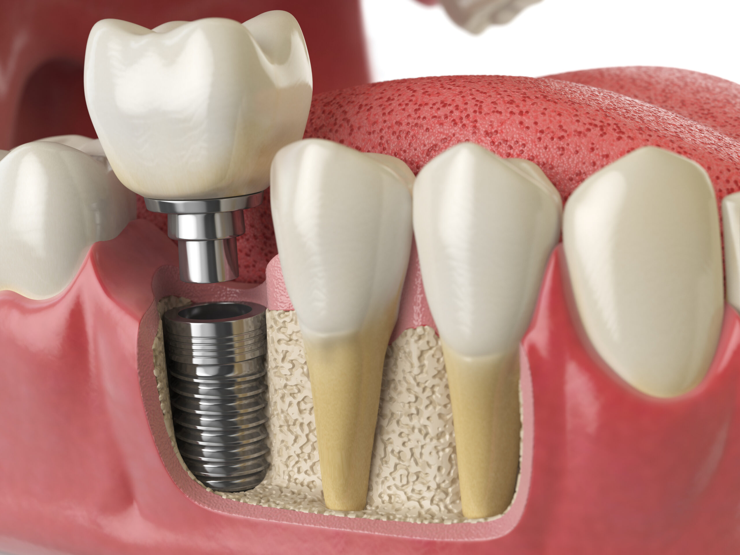 Implantes dentales: hora de recuperar tu sonrisa