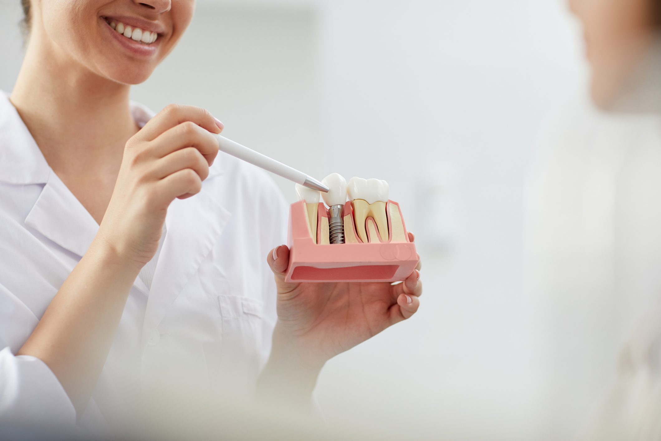 Cómo cuidar un implante dental para que dure toda la vida