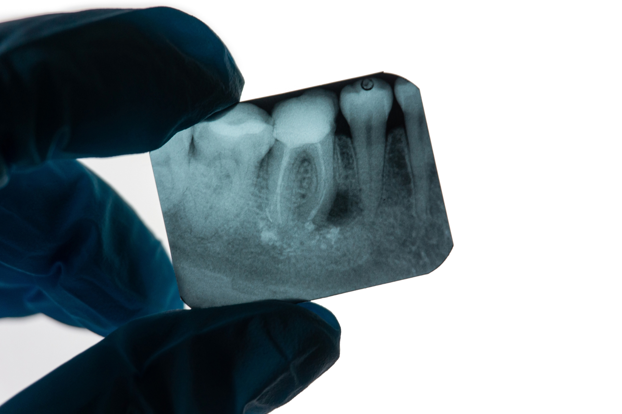 Endodoncia paso a paso: Salvando dientes dañados