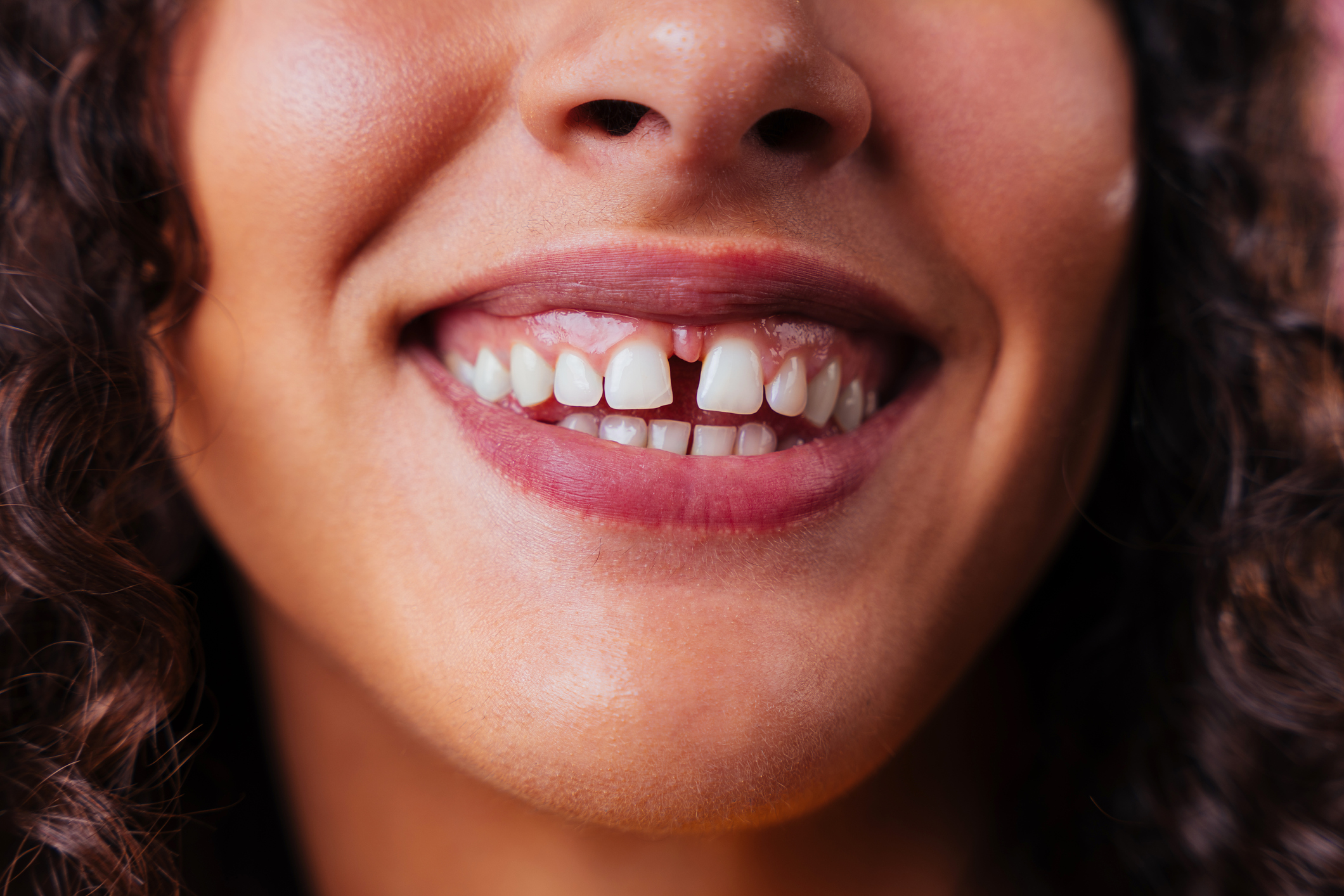 Diastema dental: causas, efectos y tratamientos