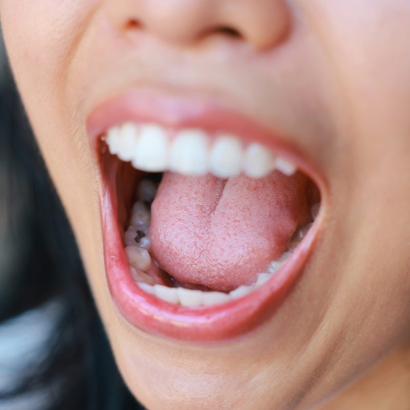 caries interproximales