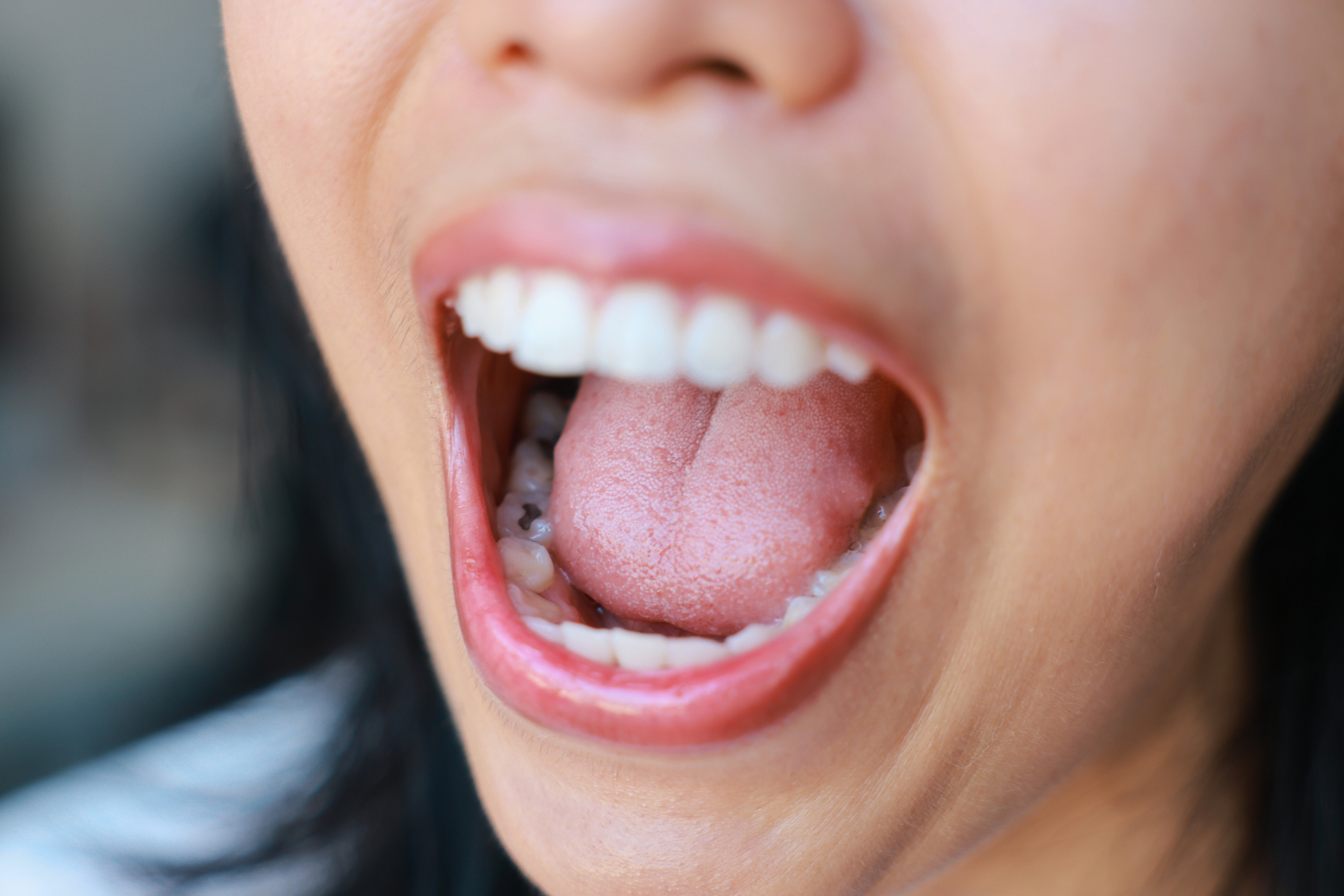 Caries interproximales: el enemigo invisible entre los dientes