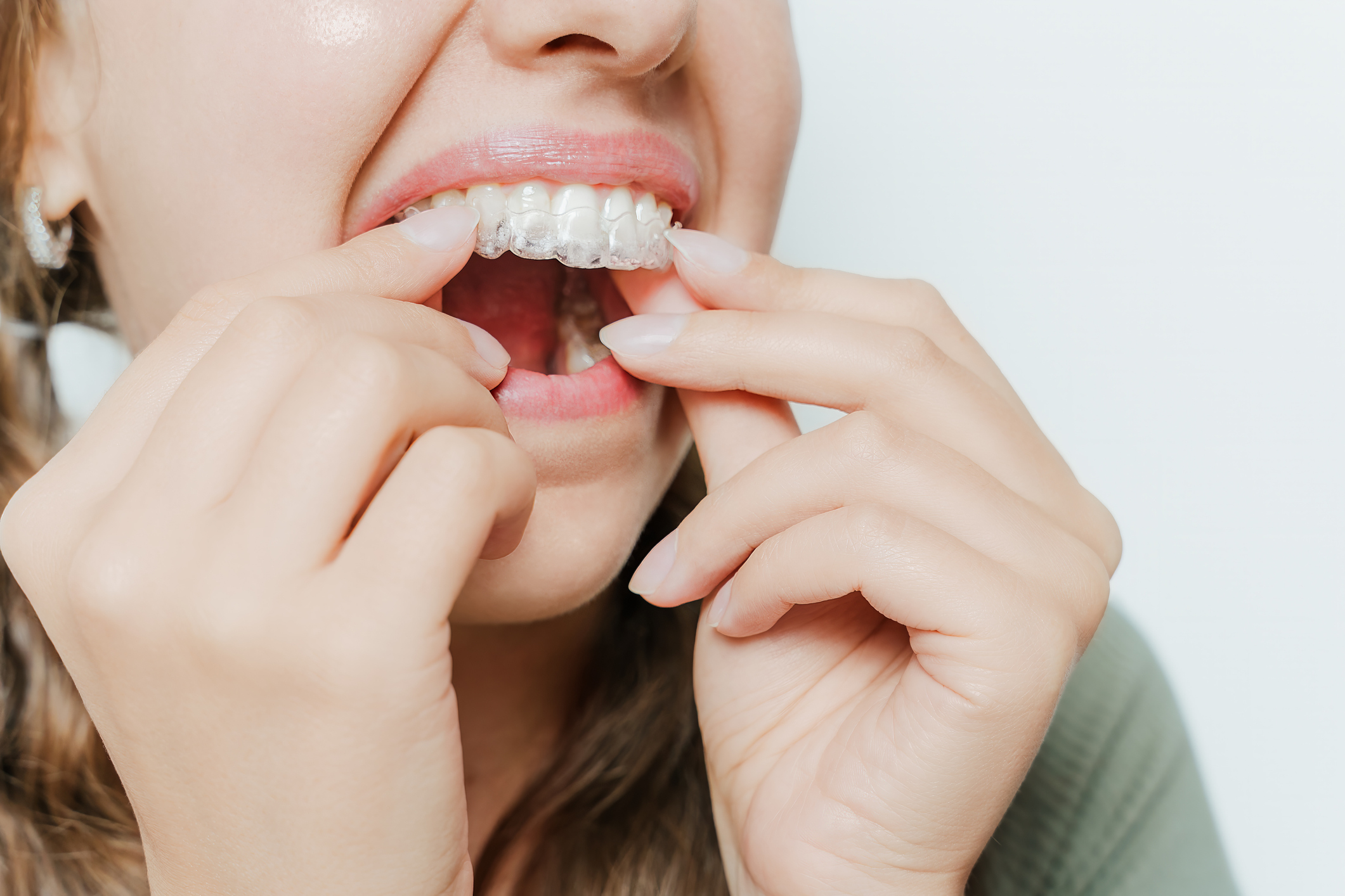 Ortodoncia y hábitos diarios: cómo el cepillado y la alimentación afectan a los resultados